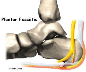 Plantar Fasciitis